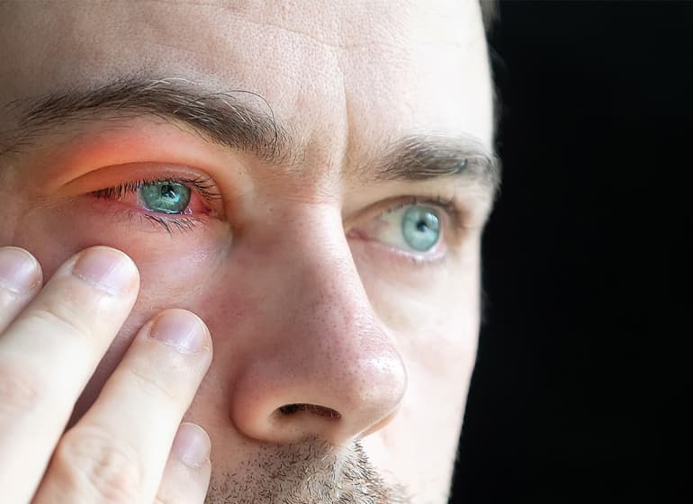 Синдром «красного глаза»